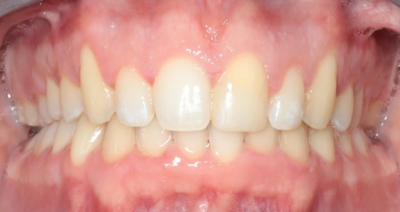 braces in irving