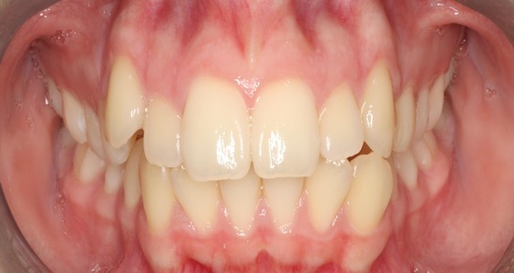 braces in irving