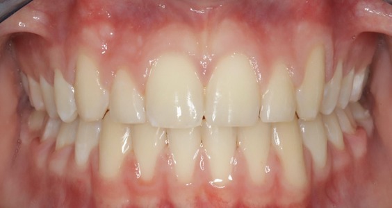 braces in irving