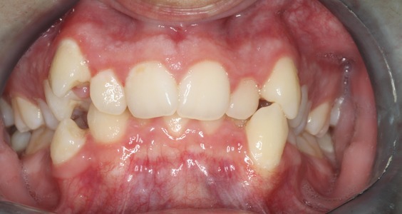 braces in irving